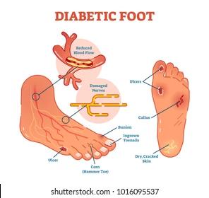 Diabetic Foot Care